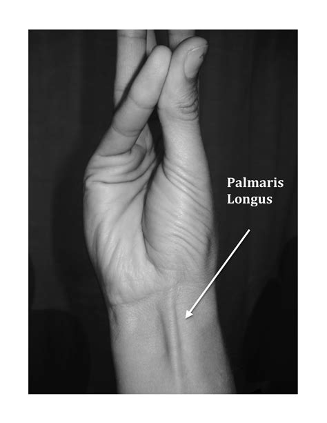 do YOU have a palmaris longus tendon?????