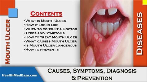 Mouth Ulcer - Causes, Symptoms, Diagnosis, Prevention - HealthMedEasy.com - Health, Medicine ...