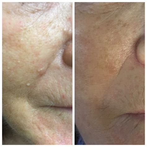 Before and after general milia removal - Skin Essentials by Mariga | Advanced Skincare Ireland