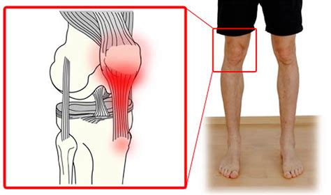 Patellar Tendinitis - Causes, Symptoms, Stretching, Exercises, Treatments