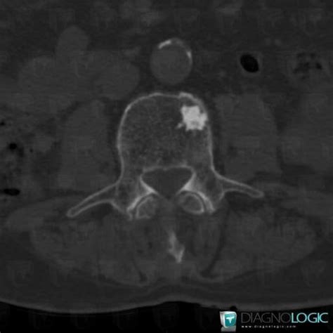 Radiology case : Bone island (CT) - Diagnologic