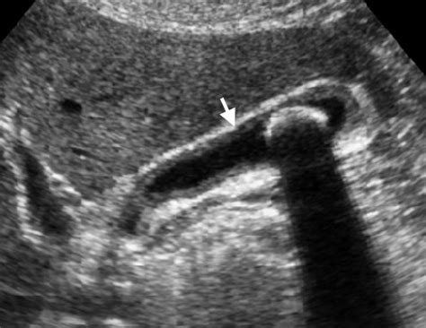 Chronic cholecystitis ultrasound - wikidoc