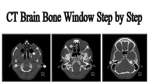 Cranial Bone Anatomy Ct Axial