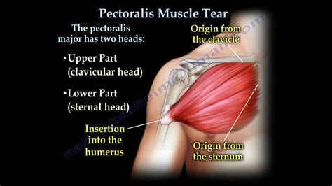 Pectoralis Muscle ,tendon Tear - Everything You Need To Know - Dr. Nabil Ebraheim - YouTube