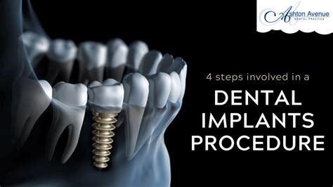 Dental Implant Procedure Step by Step - Missing Teeth Replacement ...