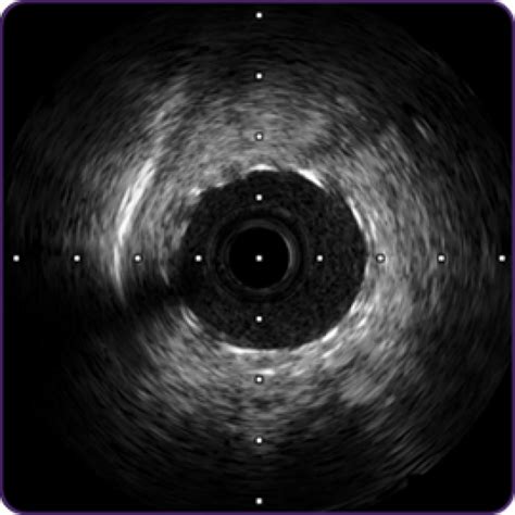 Complex PCI IVUS Catheter – OPTICROSS - Boston Scientific