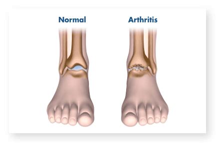 What is Ankle Replacement? | Stryker