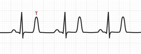 The T Wave | ECG Basics - MedSchool