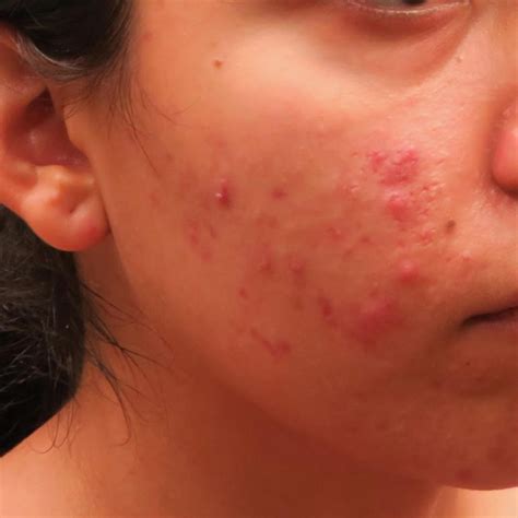 Dr. Pimple Popper Reveals the Acne You Shouldn't Pop | Reader's Digest