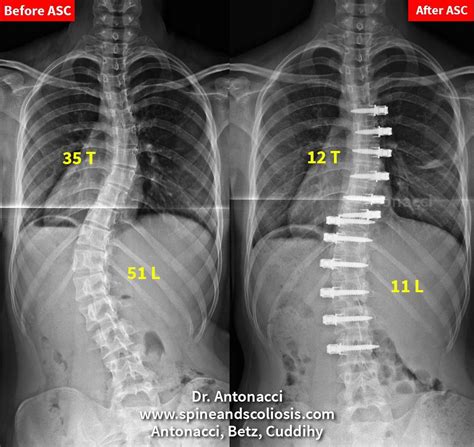 RA 16 Scoliosis Double Curve from 35 Thoracic - Institute for Spine and ...