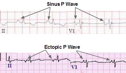 Ectopic Atrial Rhythms ECG Review | Learn the Heart