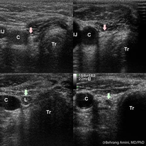 Roentgen Ray Reader: Post-Thyroidectomy Ultrasound in Patients with Differentiated Thyroid Cancer