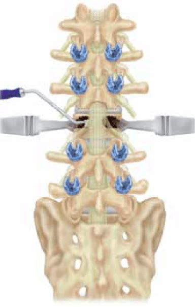 Pedicle Subtraction Osteotomy (PSO) - Matthew D. Hepler, M.D.