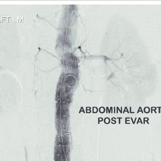 Stent graft seen in situ during EVAR procedure. | Download Scientific Diagram