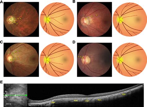 Contrast Sensitivity Function: A More Sensitive Index for Assessing ...