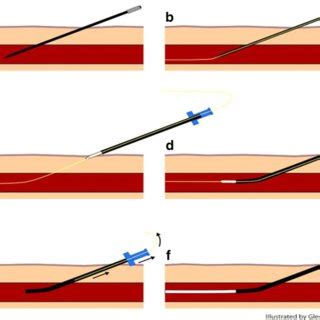 Steps of the direct sheathed needle puncture technique for placement of ...