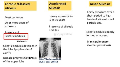 SILICOSIS - Pathology Made Simple