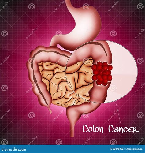 Colorectal Cancer Diagram