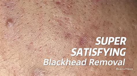 Super Satisfying BLACKHEAD REMOVAL - YouTube