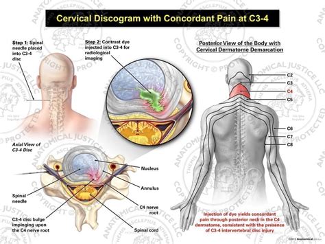 Male Left Cervical Discogram with Concordant Pain at C3-4