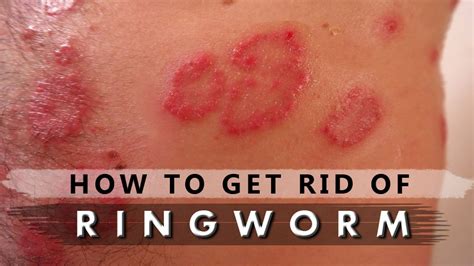 How to get rid of ringworm with home remedies Fast, Wringworm treatment - YouTube