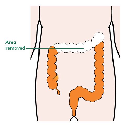 Surgery to remove colon cancer - Macmillan Cancer Support