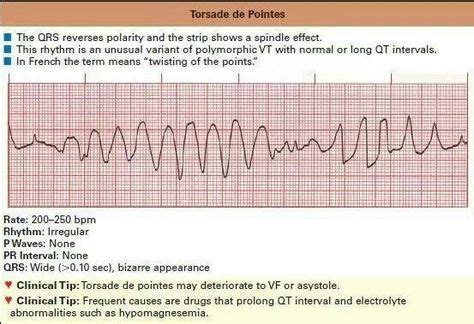 Torsade de pointes | RT | Pinterest | Pr interval, Acls, Nursing students