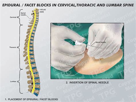 Spinal Block Vs Epidural