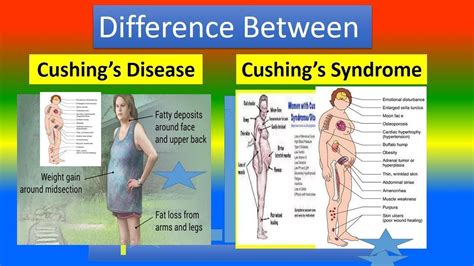 Difference Between Cushing’s Disease and Cushing’s Syndrome | Cushings syndrome, Cushing disease ...