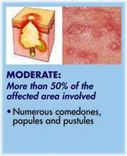 Acne Causes, Treatments & Prevention Guide – EruptingMind