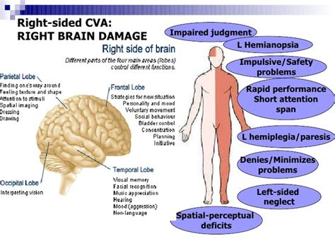 Right Hemisphere Stroke - Milka Clarke Stroke Brain Trauma Foundation