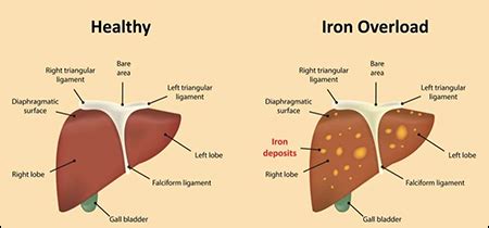 Iron Overload Disorder