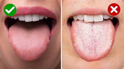 5 Things a White Tongue May Reveal About Your Health | Power of Positivity