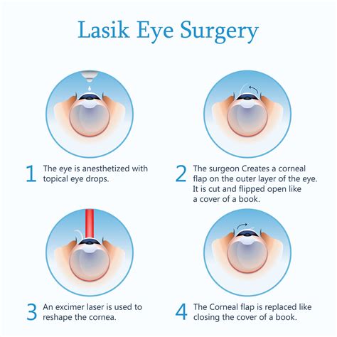 Refractive Surgery - Visalia Eye Center