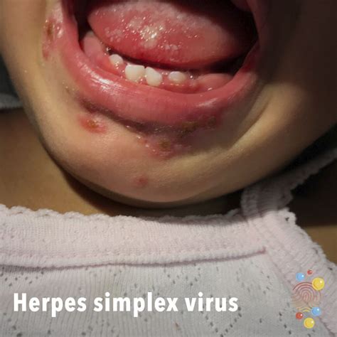 Herpes simplex virus - Skin Deep