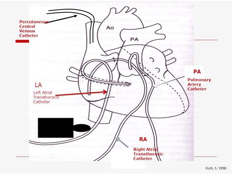 Transthoracic Intracardiac Catheters (TICs) - Pediatric CCRN Review Blog