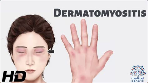 Dermatomyositis: Everything You Need To Know - YouTube