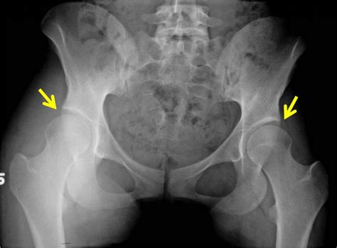 PAO surgery in young female patient with hip dysplasia - John C. Clohisy, MD