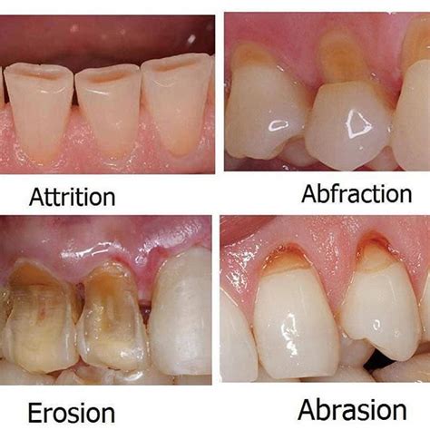 DIFFERENCE BETWEEN ABFRACTION, ABRASION, EROSION AND ATTRITION | The Dental Arcade – Blog