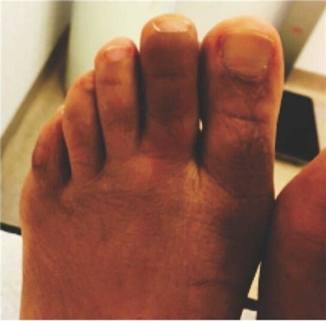 Diffuse swelling of the second right toe ("sausage" like) consistent ...