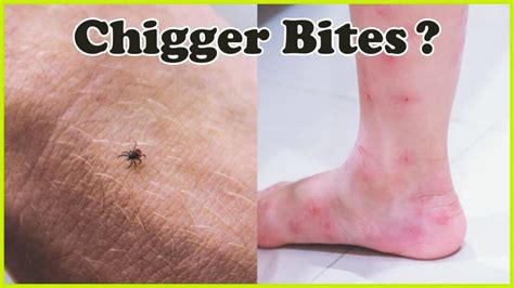 How to get rid of chiggers? - Thanos Home