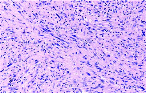 Spindle cell sarcoma histopathology 100 x magnification. | Download Scientific Diagram