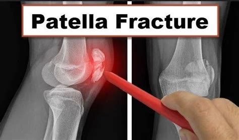 Patella Fracture: Types, Symptoms, Treatment, and Surgery – Orthopedic Treatment and Exercise