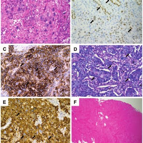 Histological examination of a tumor specimen. (A) Most of the tumor ...