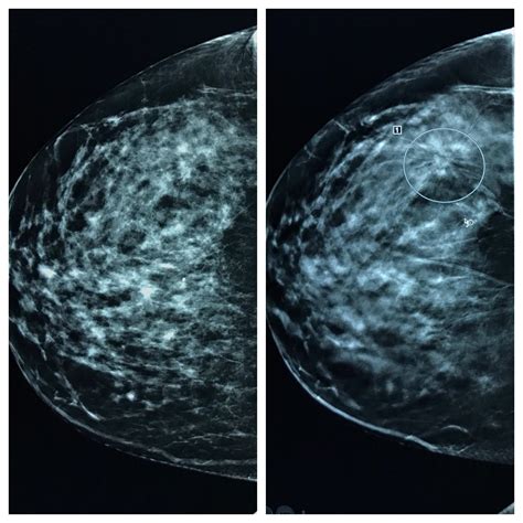 Breast Cancer Digital Mammogram