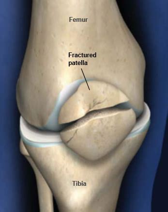 Patella Fracture (Broken Knee Cap) | Central Coast Orthopedic Medical Group