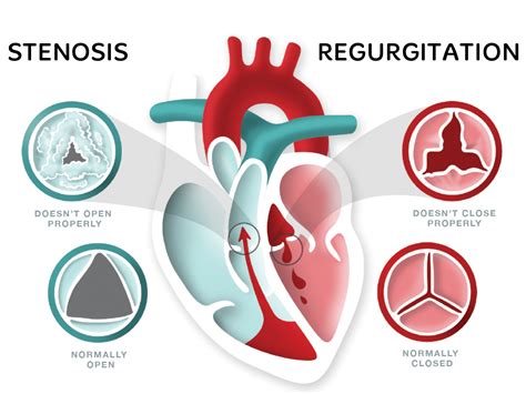 What Is Heart Valve Disease? - Heart Foundation