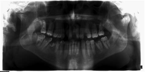 Temporomandibular Joint Arthroscopy versus Arthrotomy | IntechOpen