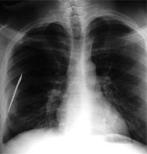 Anterior-posterior chest X-ray prior to surgery | Download Scientific Diagram