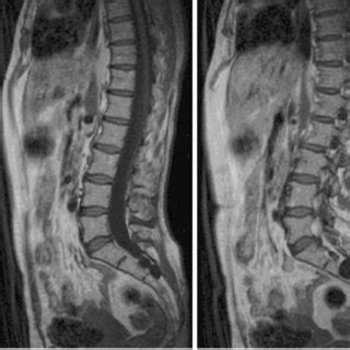 (PDF) Tarlov cysts: Clinical evaluation of an italian cohort of patients